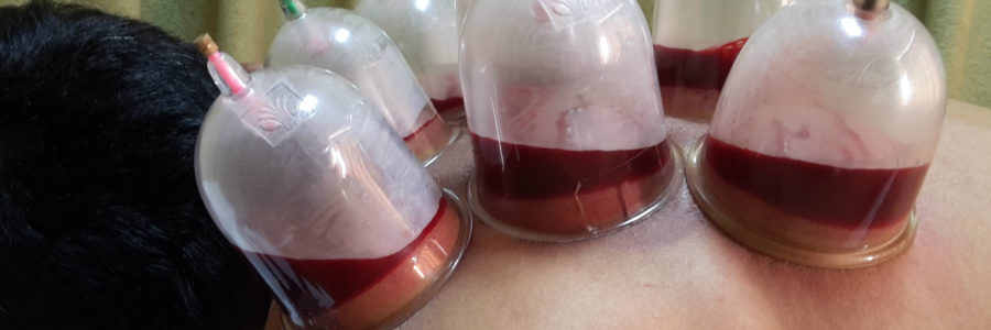 Ventosas eliminam toxinas do corpo
